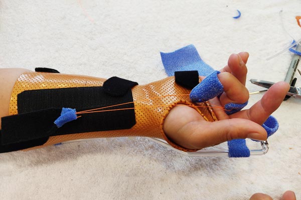 Ergo Aktiv Haiger // Handtherapie Schienen